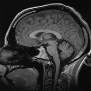 coupe d’un cerveau humain en vue latérale par IRM